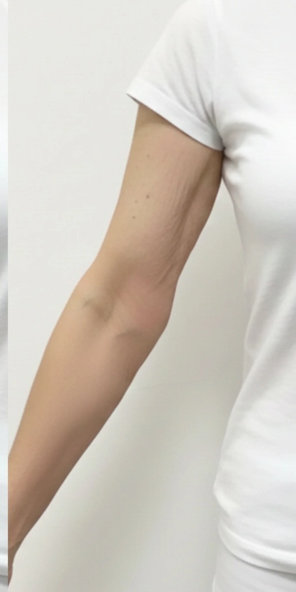 After on upper arm