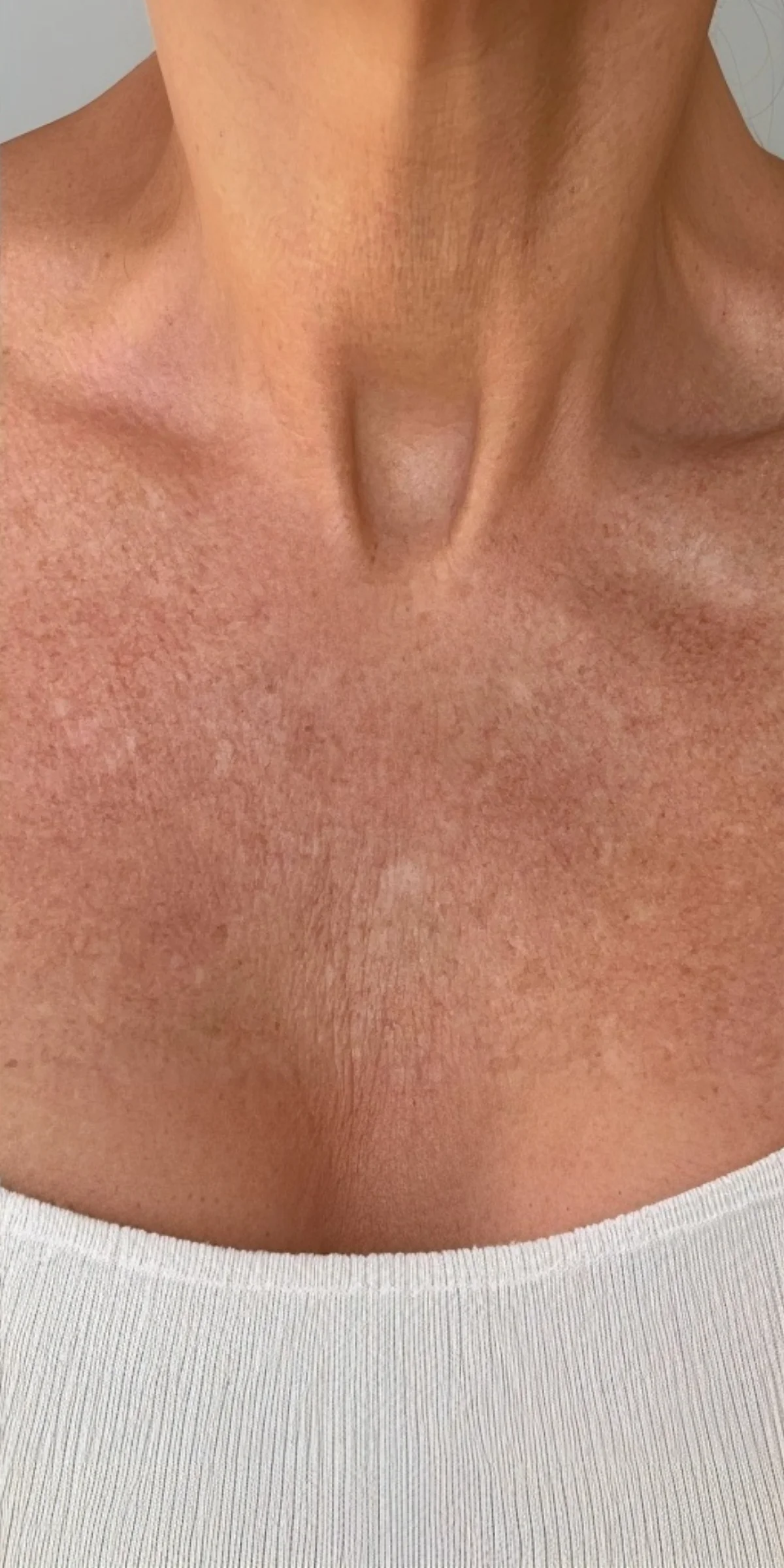After on chest